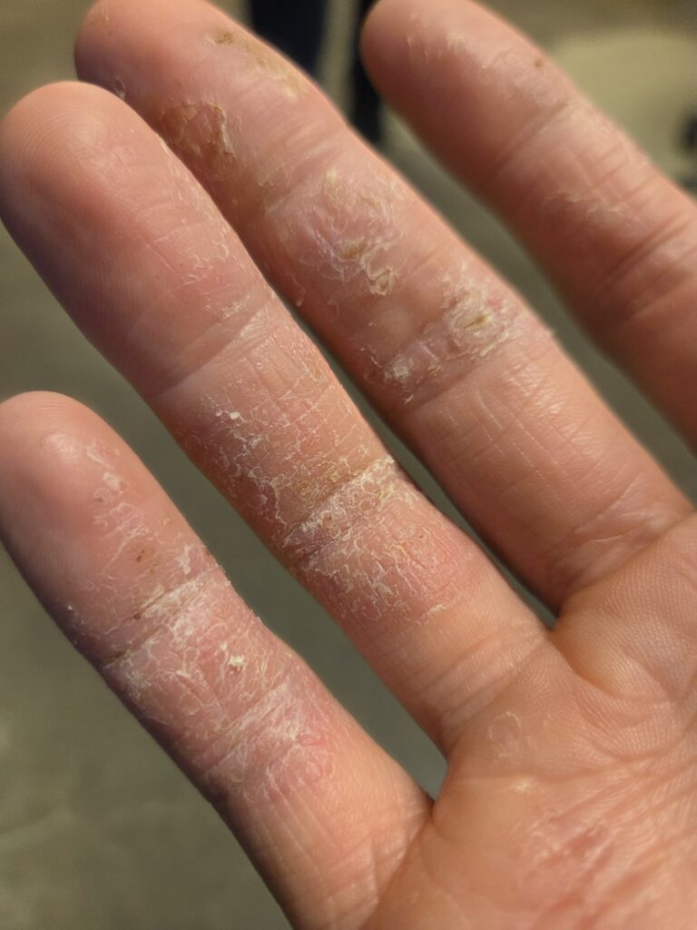 Hand with eczema