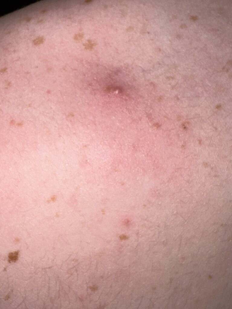 Skin blemish